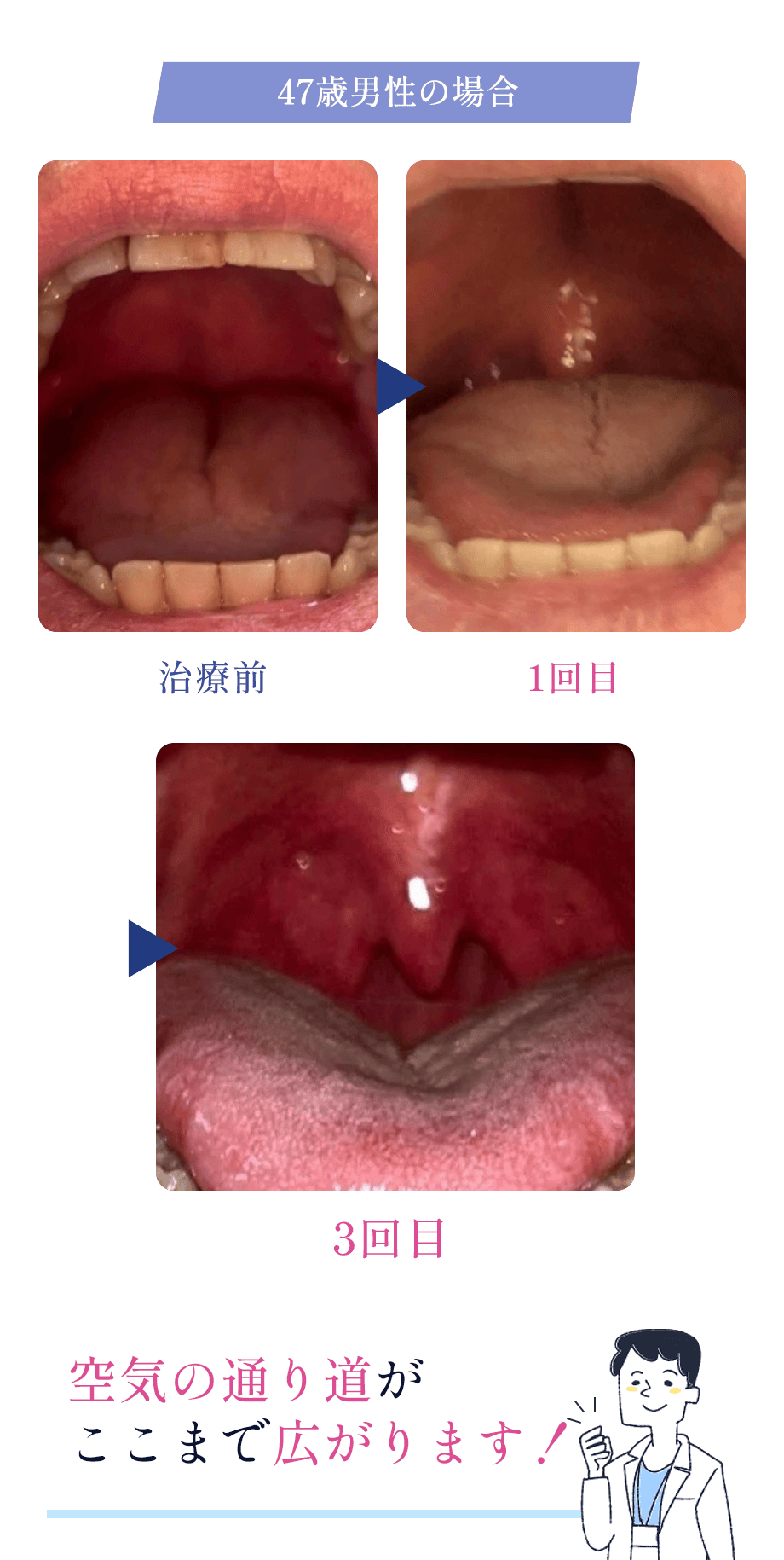 最新いびきレーザー治療　FOTONAナイトレーズ症例
