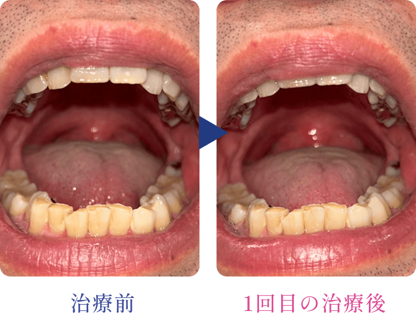 最新いびきレーザー治療　FOTONAナイトレーズ初回症例