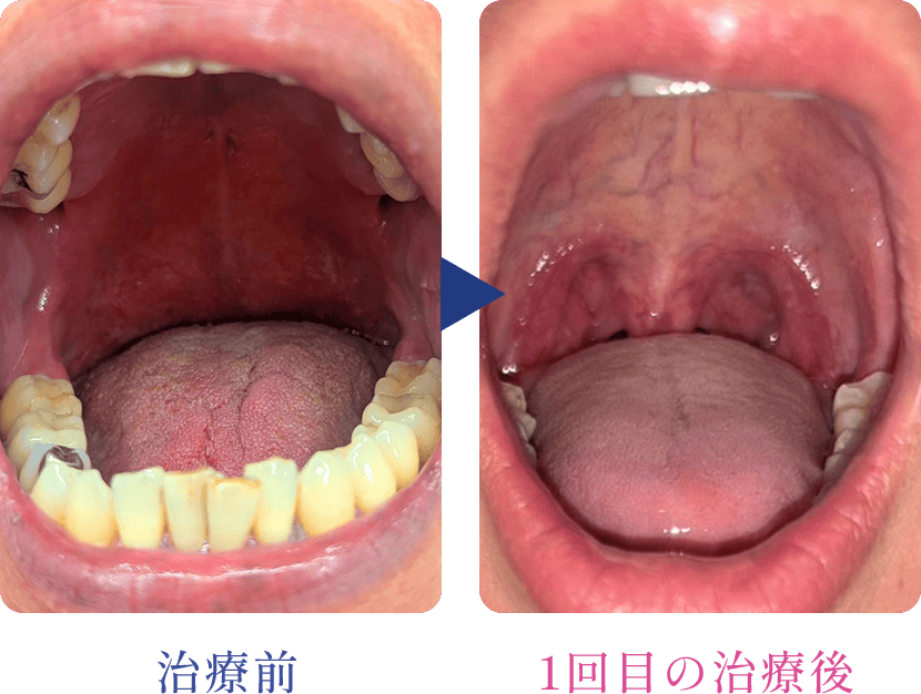 最新いびきレーザー治療　FOTONAナイトレーズ初回症例