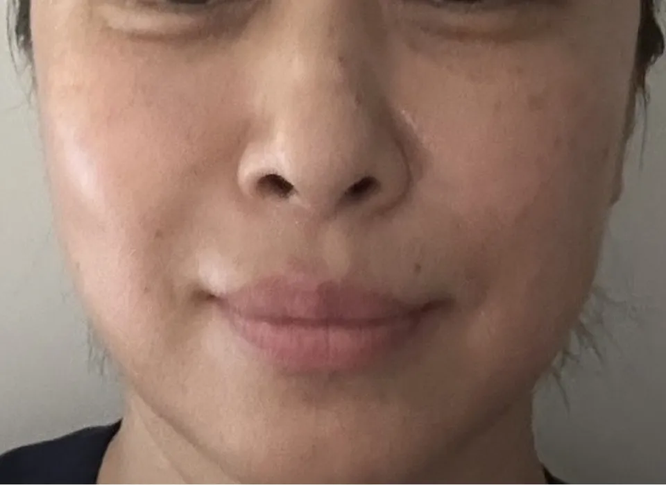 水光注射施術後1日目