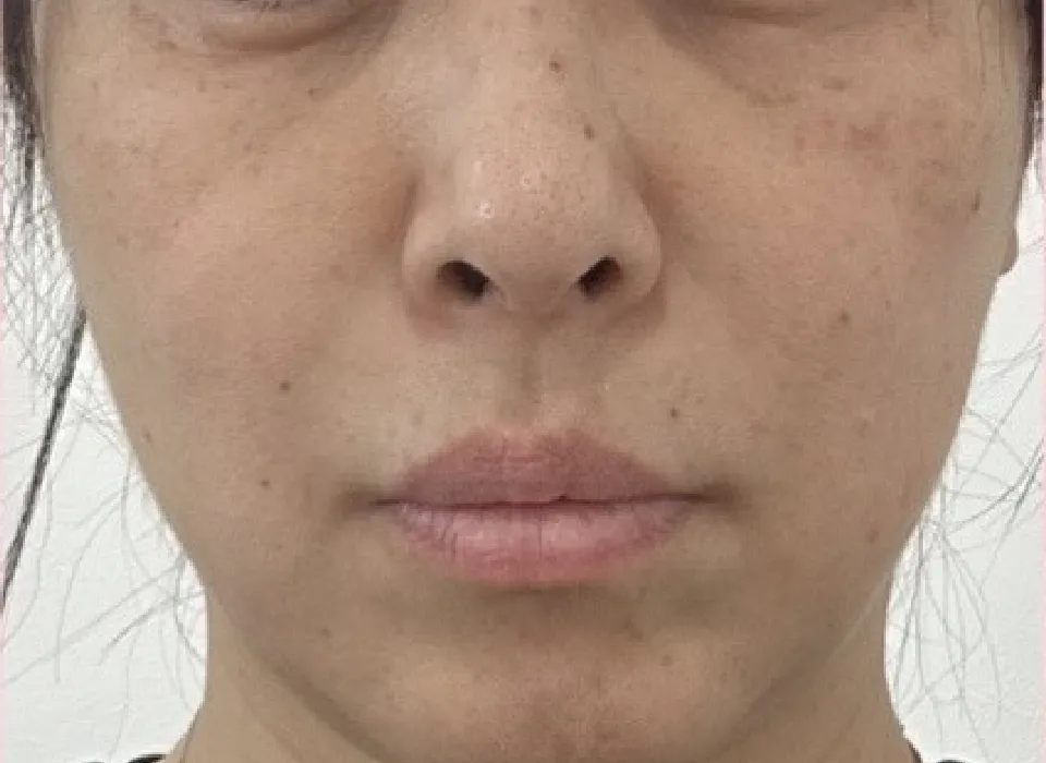 水光注射施術前